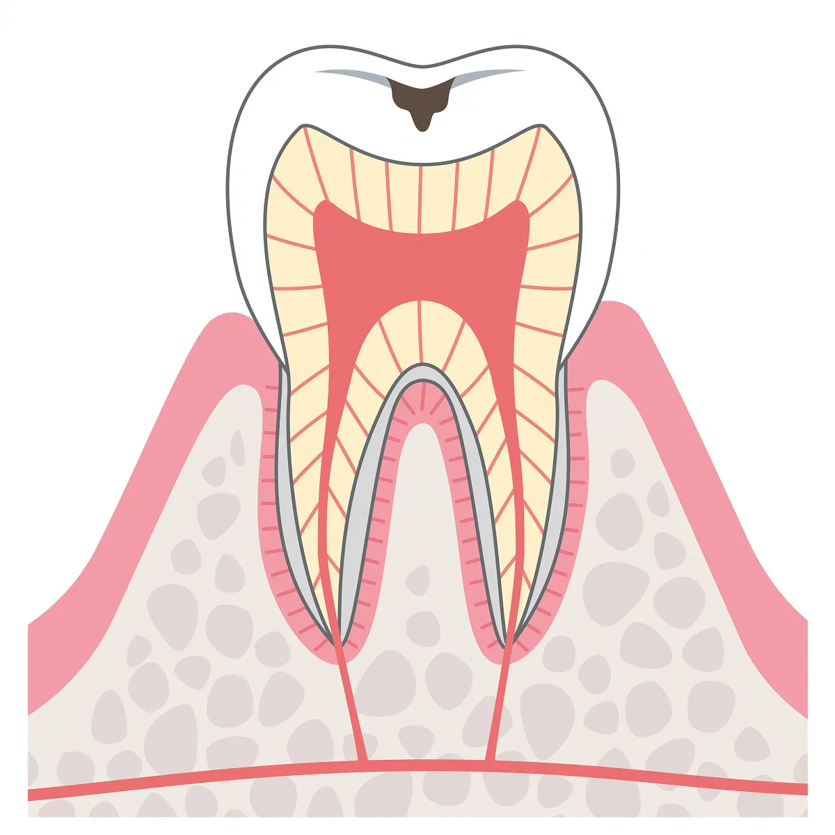 C1.エナメル質に小さな穴が開いたむし歯